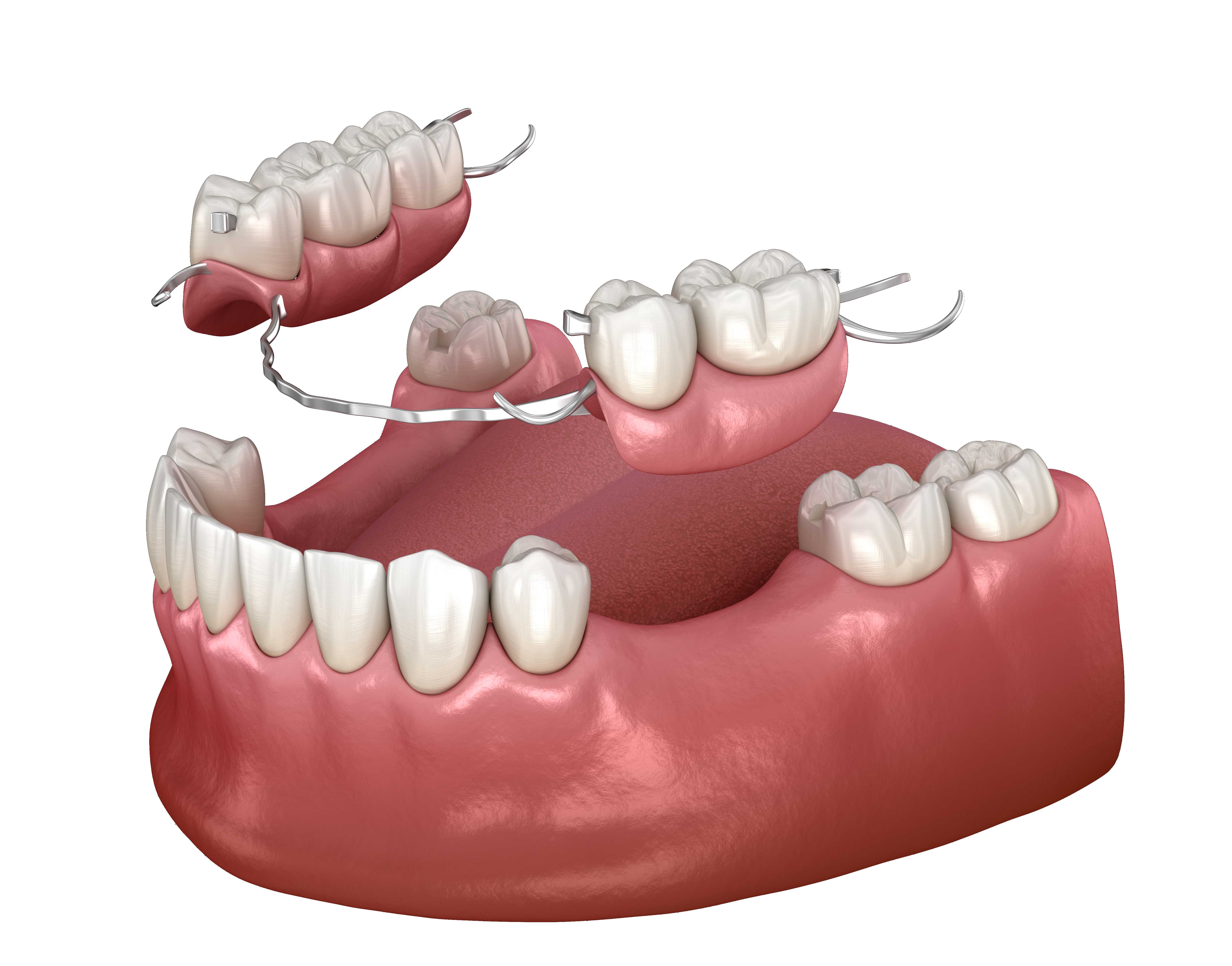 denture 様　NEIGHBORHOOD Harrisburg Dentures | Give Your Smile a Second Chance